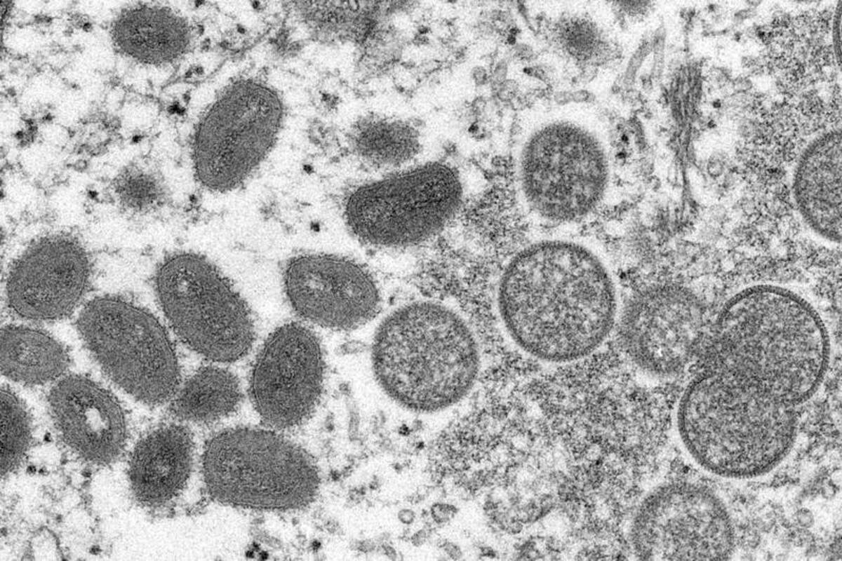 EU: Se confirma nuevo caso de viruela del mono en Nueva York