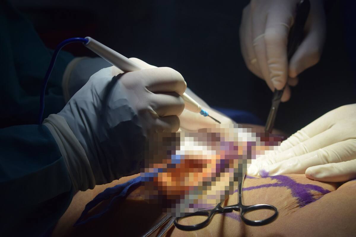 VIDEO: Madre necesita reconstrucción de trasero tras fallido procedimiento cosmético