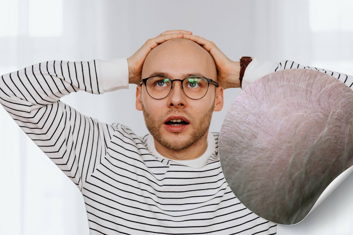 Lo que muchos no saben sobre el trasplante capilar, revela un experto