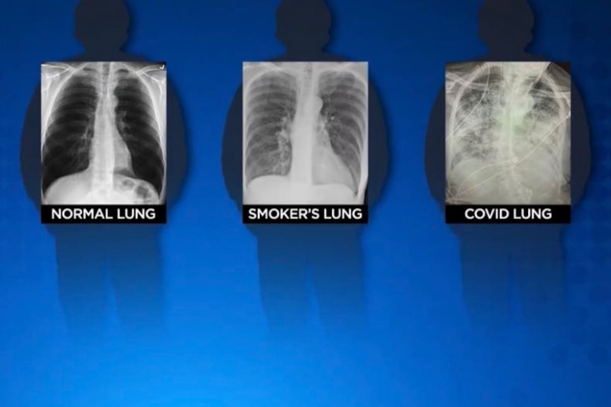 Covid-19 daña más a los pulmones que el cigarro: experta
