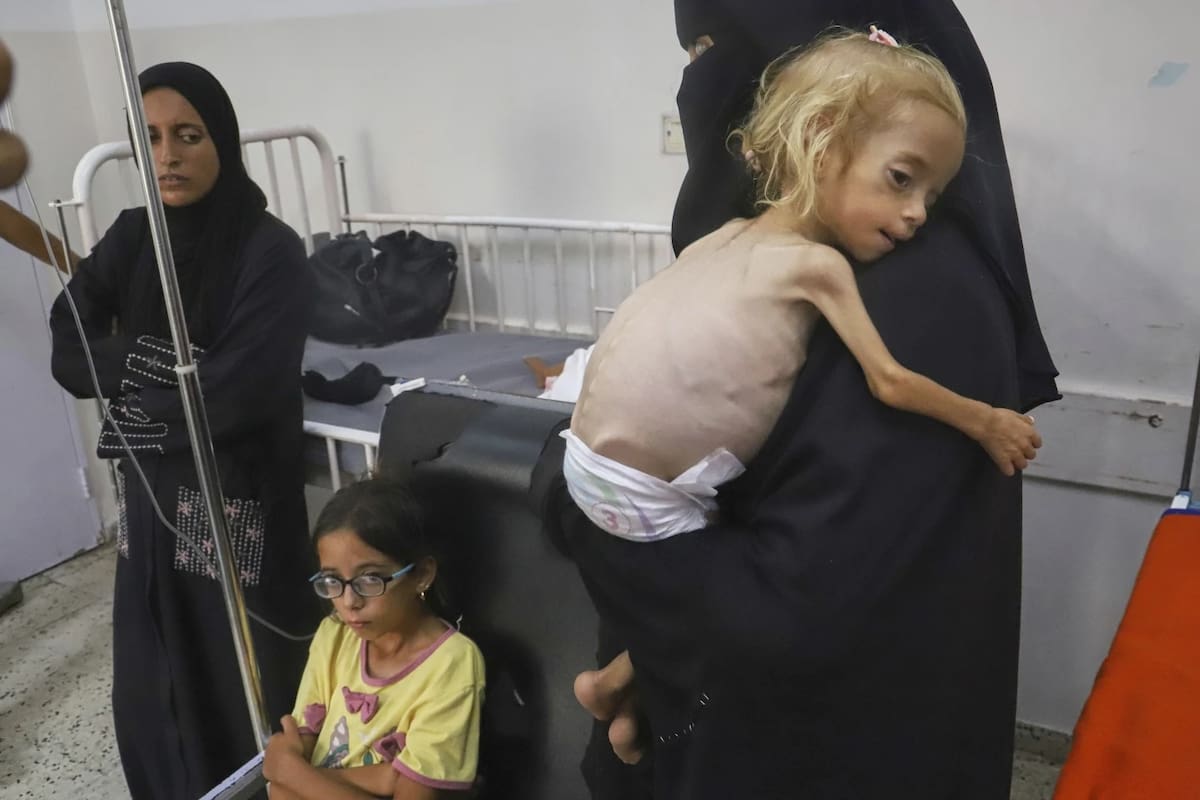 Islam Qudeih sostiene a su hija de 2 años, Shamm, con desnutrición severa y sin camisa, en el Hospital Nasser de Khan Younis, al sur de la Franja de Gaza, el sábado 9 de agosto de 2025. | Crédito: AP/Mariam Dagga