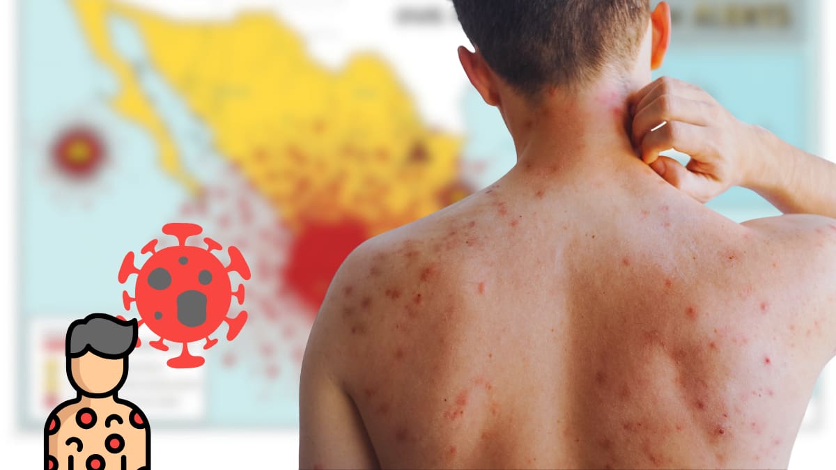 ¿Cuánto dura el sarampión y qué hacer ante un contagio? Esto indica la OMS frente al brote en México