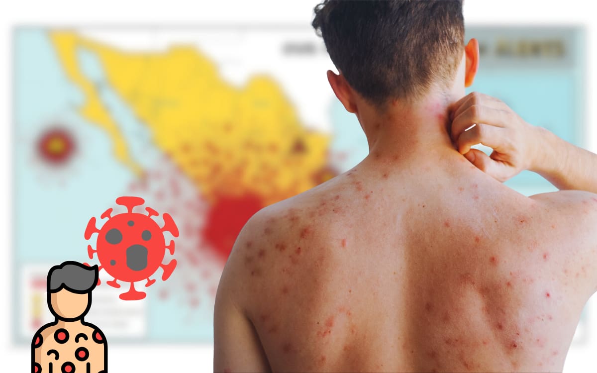 Sarampión en México: cuánto dura la enfermedad y cuál es el protocolo ante un contagio, según la OMS. Foto: Canvas