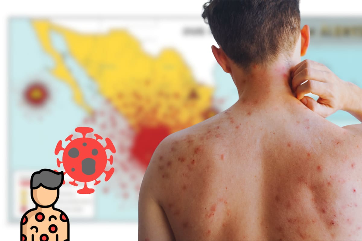 ¿Cuánto dura el sarampión y qué hacer ante un contagio? Esto indica la OMS frente al brote en México