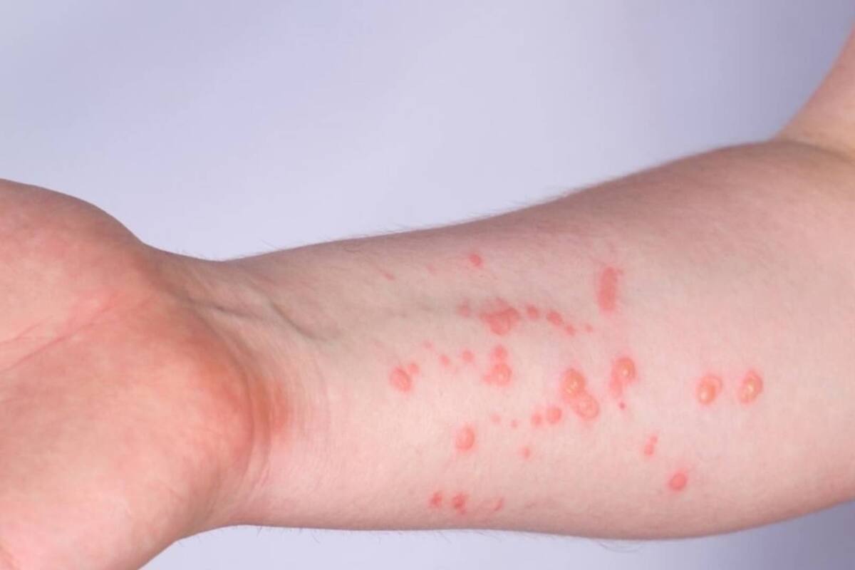 Viruela del mono: registran tres nuevos casos en Mazatlán, Sinaloa