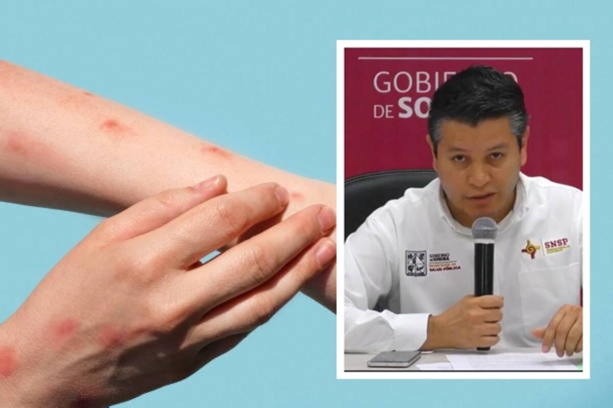 Salud Sonora vigila contactos de Mpox en Hermosillo y SLRC