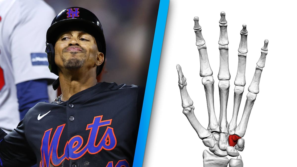 ¿Qué es el hueso ganchoso y por qué los beisbolistas sufren esta dolorosa lesión?