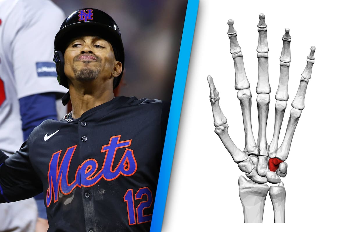 ¿Qué es el hueso ganchoso y por qué los beisbolistas sufren esta dolorosa lesión?