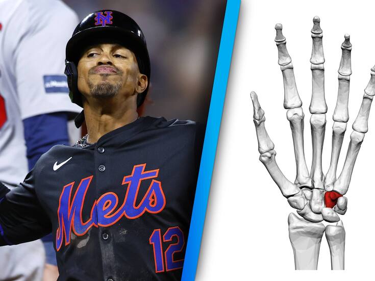 ¿Qué es el hueso ganchoso y por qué los beisbolistas sufren esta dolorosa lesión?