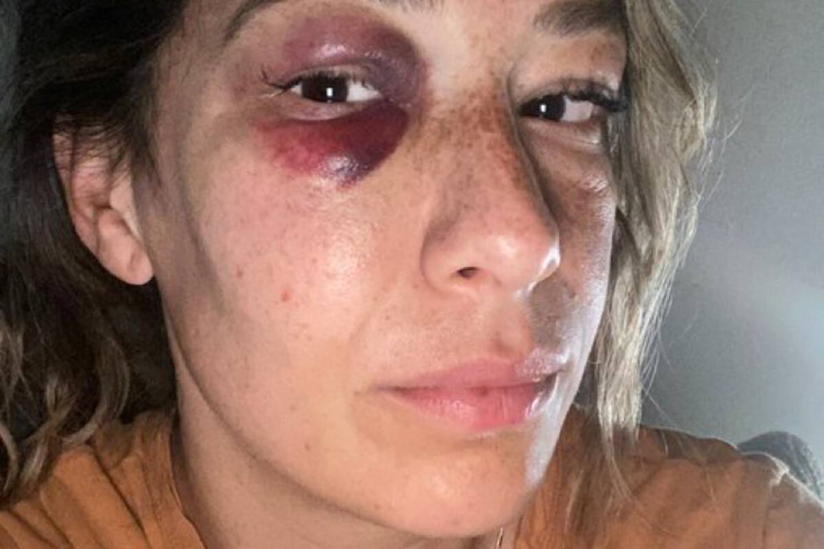 Jugadora de Xolas recibió codazo y todavía fue amonestada