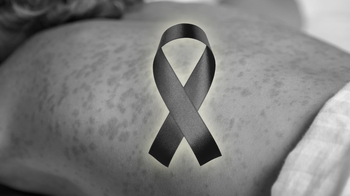Muere un niño por sarampión en Cajeme, Sonora luego de detección de casos en un campo agrícola. | Especial