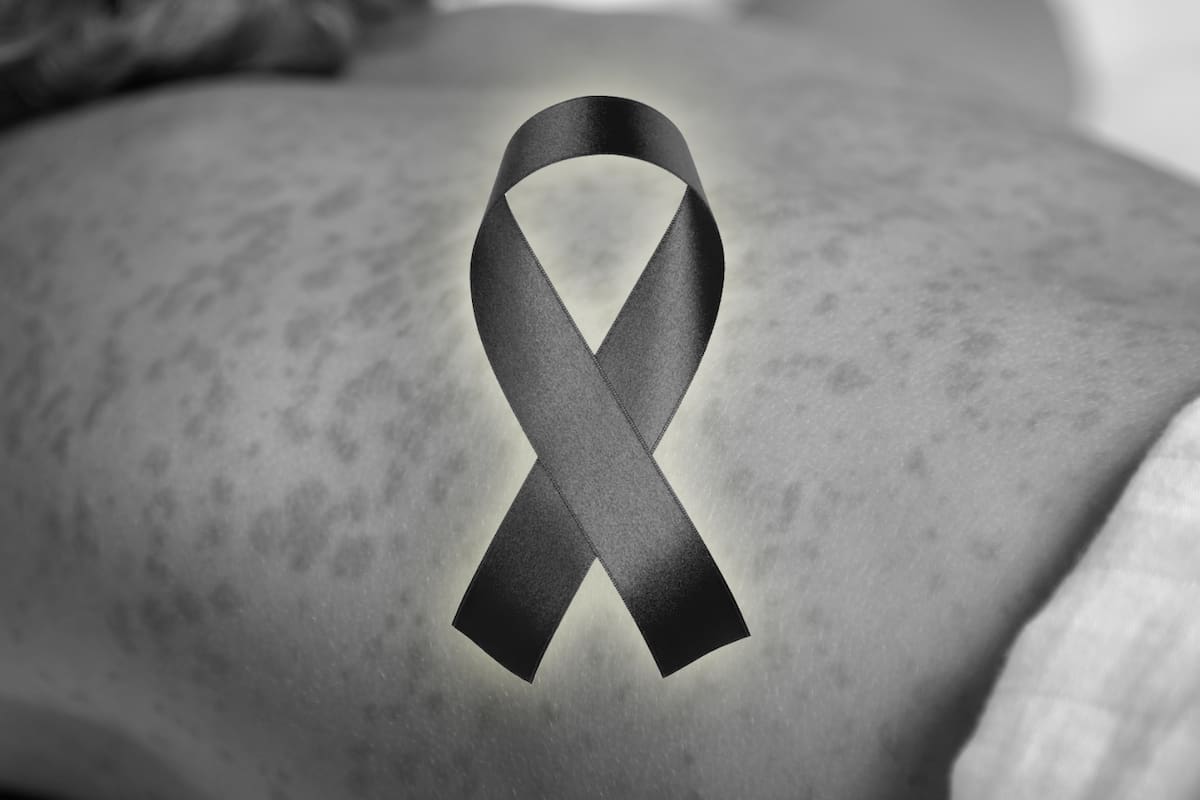 Fallece bebé por sarampión en Cajeme