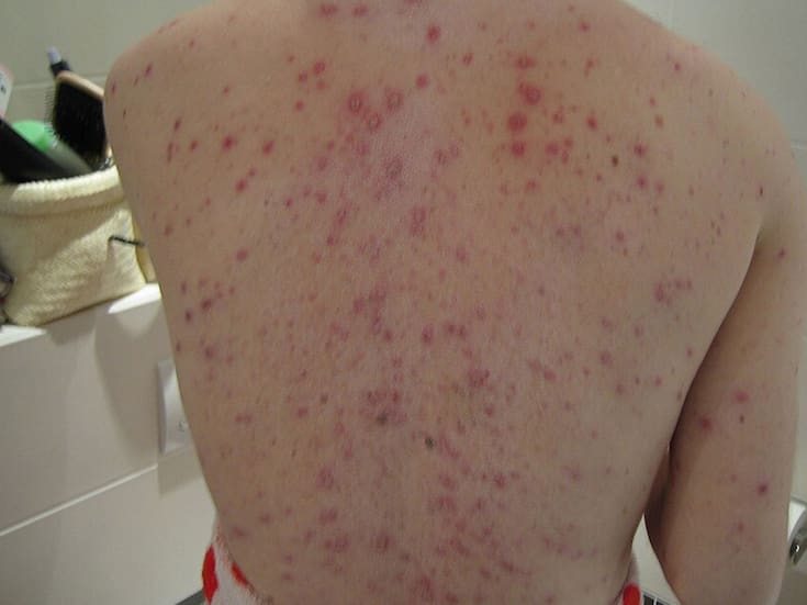 Varicela sigue siendo frecuente en Sinaloa, aunque sin hospitalizaciones recientes de menores