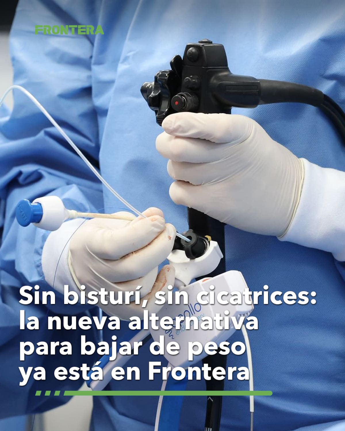 La manga gástrica por endoscopia es una técnica ambulatoria que reduce el estómago. Foto: Cortesía