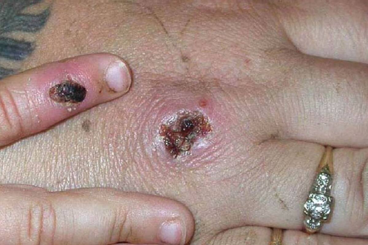 Viruela del mono: lo que se sabe del inusual brote detectado en varias regiones
y por qué no será "como otra pandemia de covid"