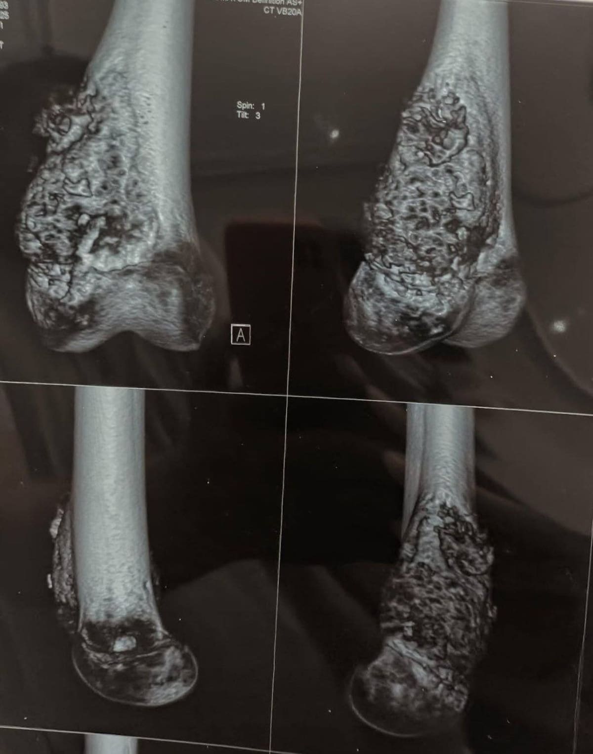 Tras 21 quimioterapias y una cirugía de fémur, Yerin Morales necesita plaquetas A u O positivo para concluir su tratamiento contra el cáncer
