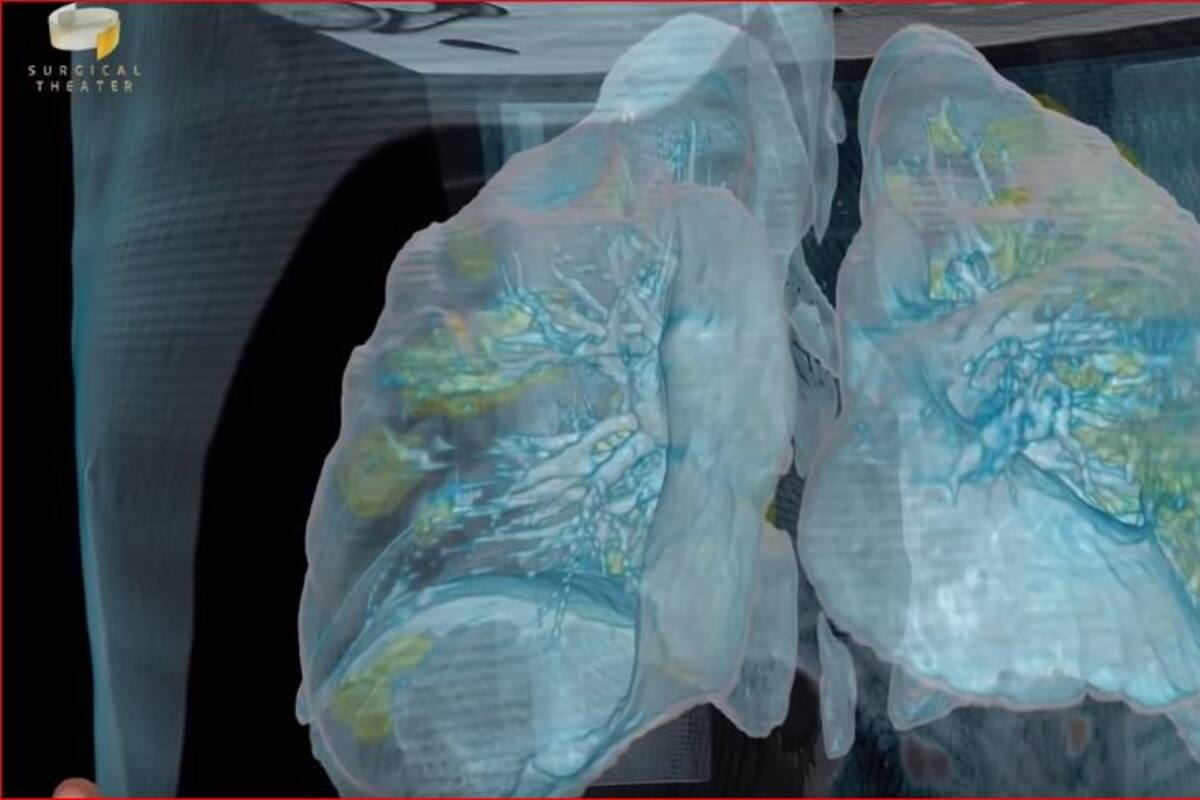 Muestran en video el daño que hace el coronavirus a tus pulmones