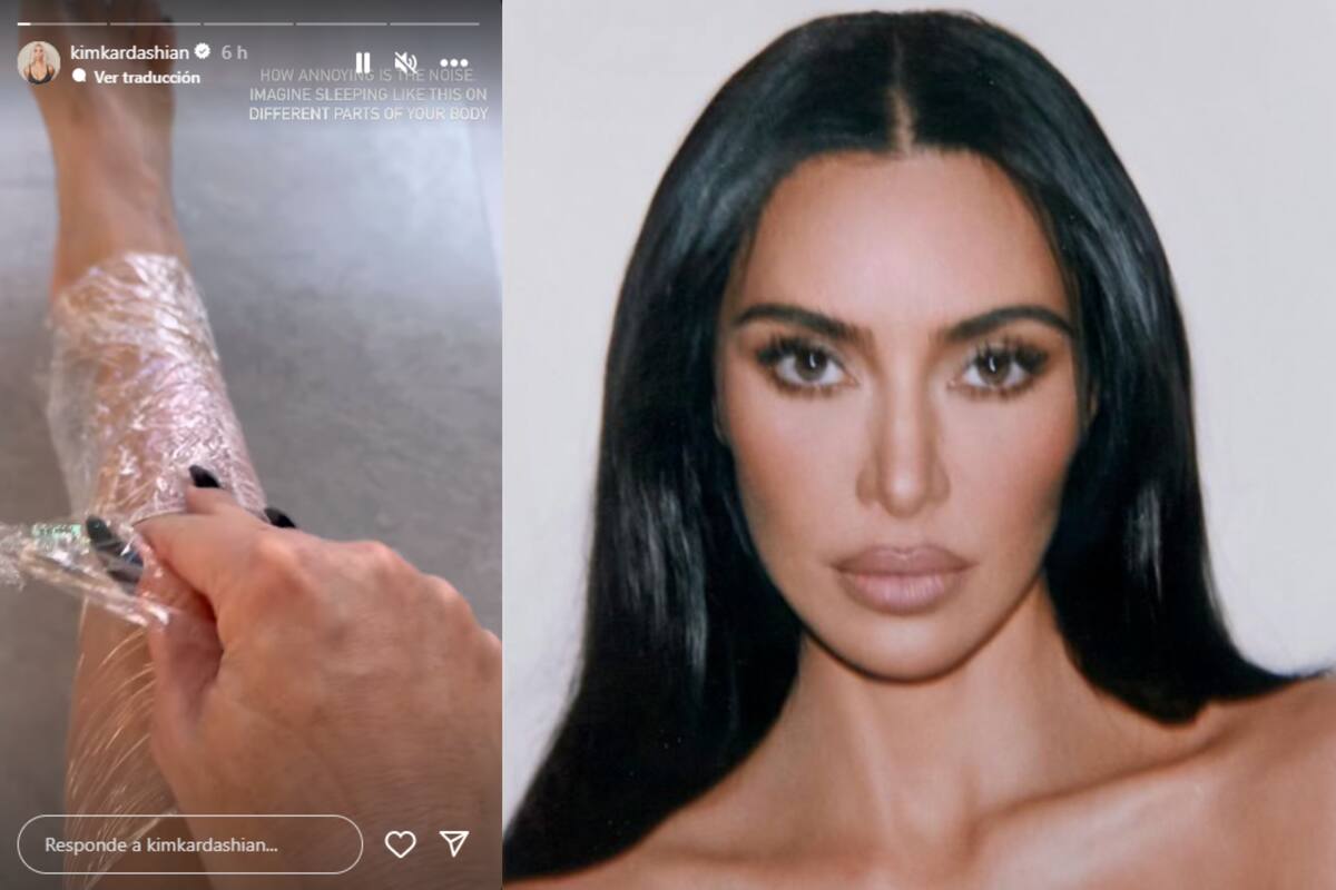 ¿Qué es la psoriasis? Es la enfermedad que padece Kim Kardashian