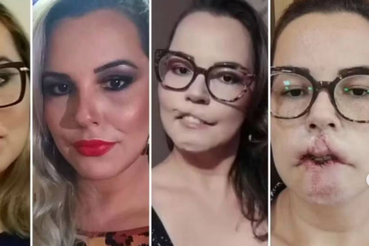 Influencer pierde los labios tras someterse a tratamiento estético
