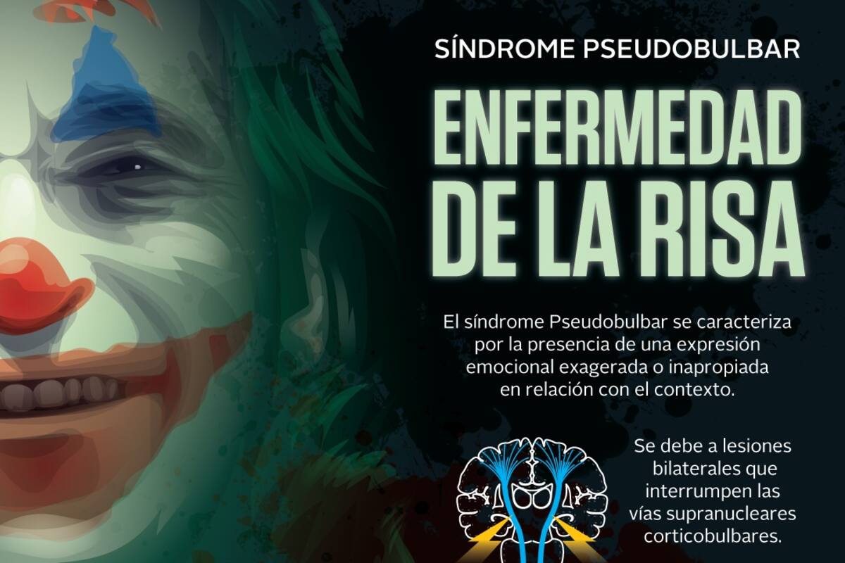 Enfermedad de la risa