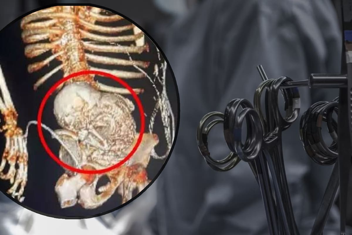 Anciana de 81 años muere por “bebé de piedra” que cargó en su cuerpo más de 30 años