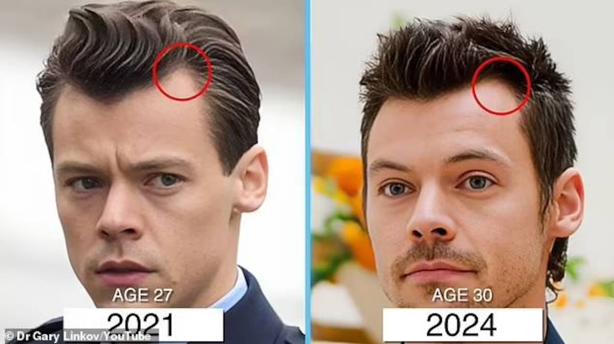 El objetivo era promover el crecimiento de nuevo cabello de Styles.