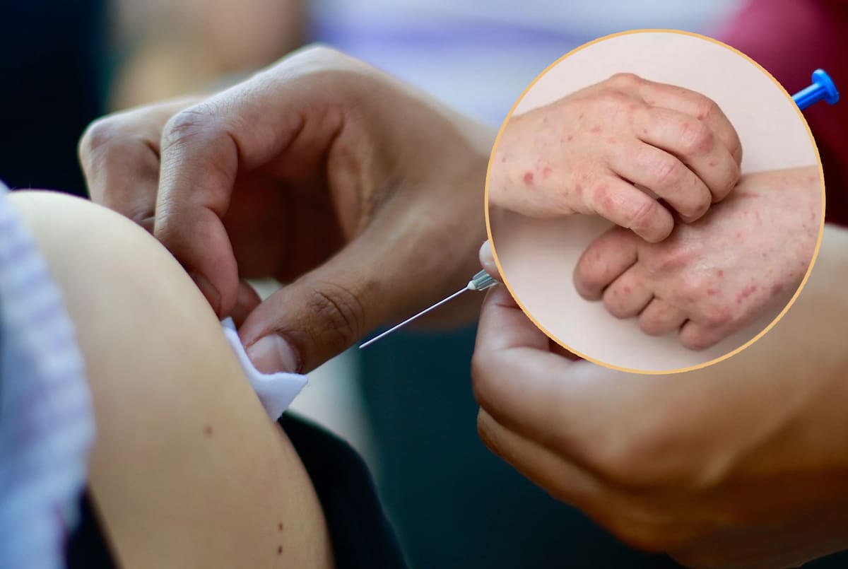 El sarampión es una enfermedad altamente contagiosa que se transmite por vía respiratoria. Foto: Archivo