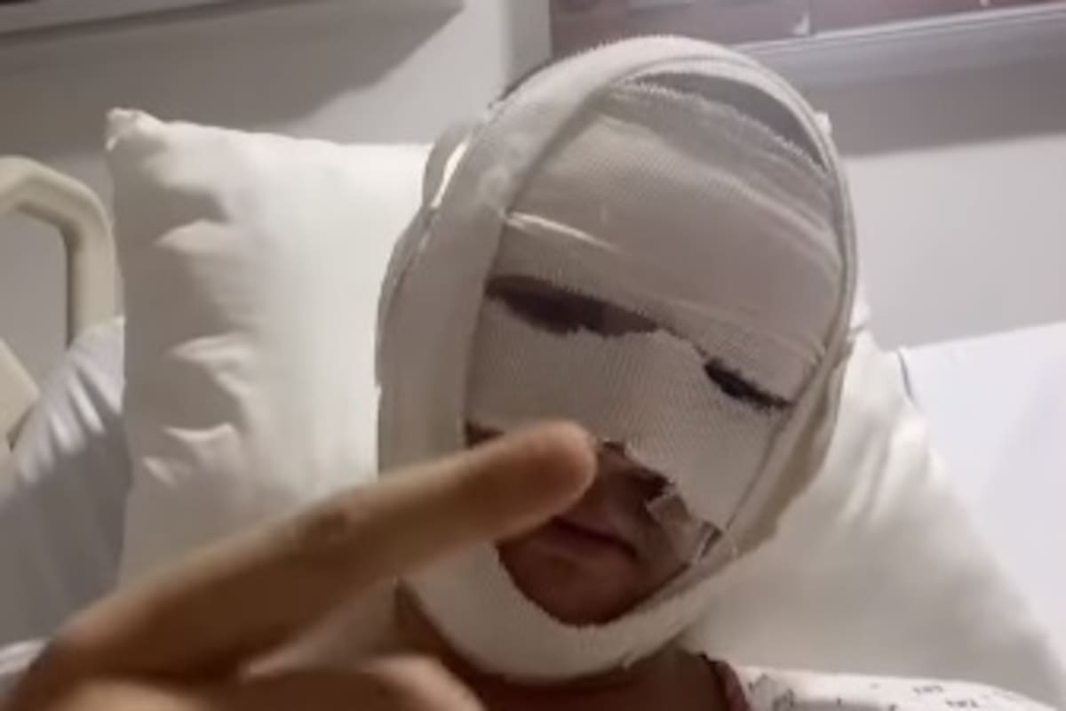 Omar Yubeili se quemó el rostro en terrible explosión de gas