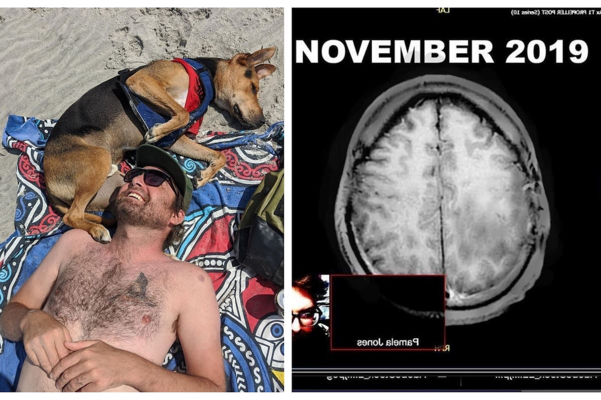 Hombre sufre de un raro moho negro tóxico que crece en su cerebro después de rasparse el codo en vacaciones