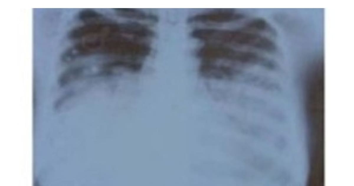 ¡Alerta Sanitaria en Arizona! Primer Fallecimiento por Peste Neumónica en 17 Años: Todo lo que Necesitas Saber