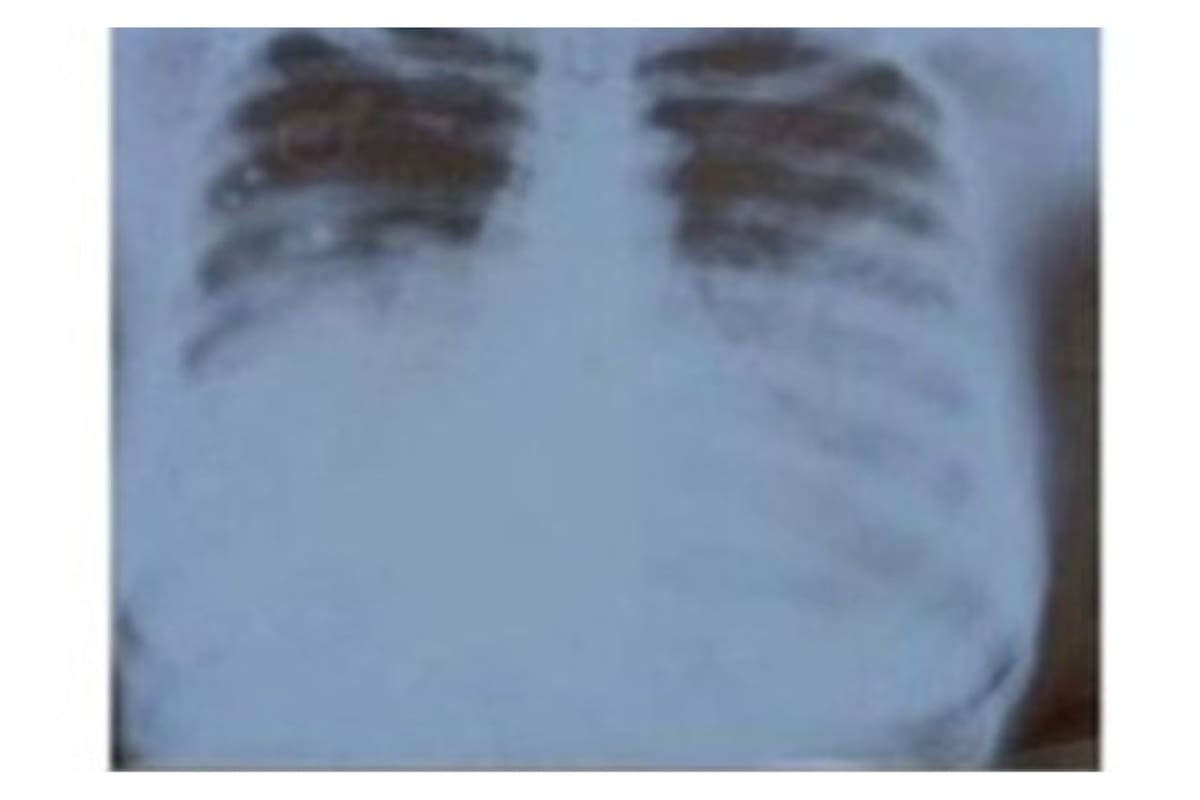 Primera muerte por peste neumónica en Arizona desde 2007: lo que debes saber