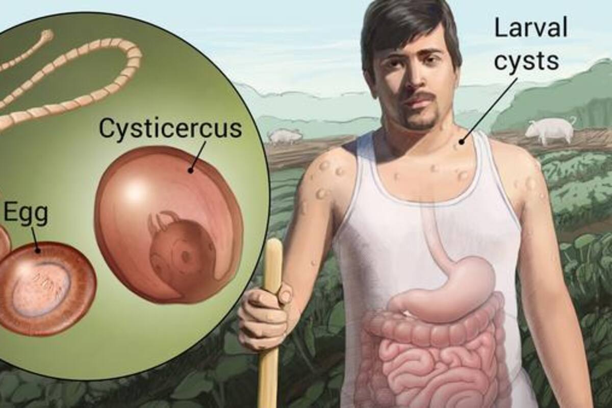 ¿Qué es la cisticercosis, enfermedad que habría acabado con la vida de Sebastián Ferrat?
