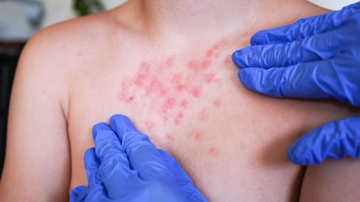 Organización Panamericana de la Salud convoca a México y Estados Unidos a revisión por brotes de sarampión. / Imagen ilustrativa de archivo.