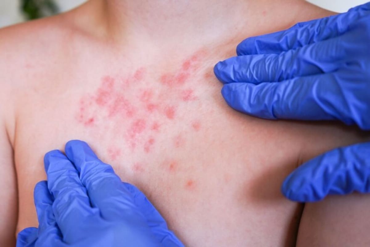 Baja California, entre los cinco estados con más casos probables de sarampión