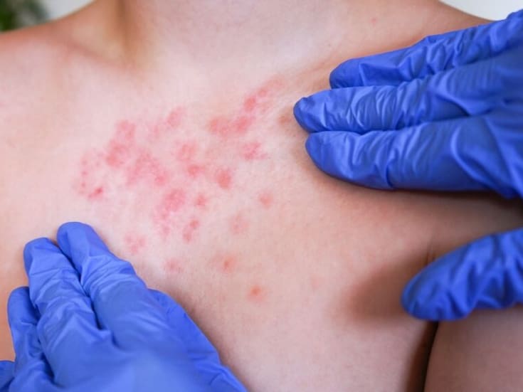 Organización Panamericana de la Salud convoca a México y Estados Unidos a revisión por brotes de sarampión