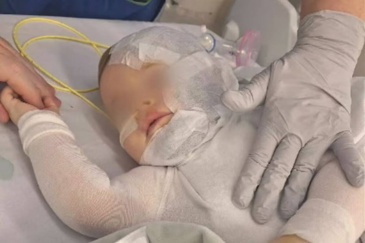 Un bebé de 9 meses sufrió múltiples quemaduras muy graves. FOTO: Especial