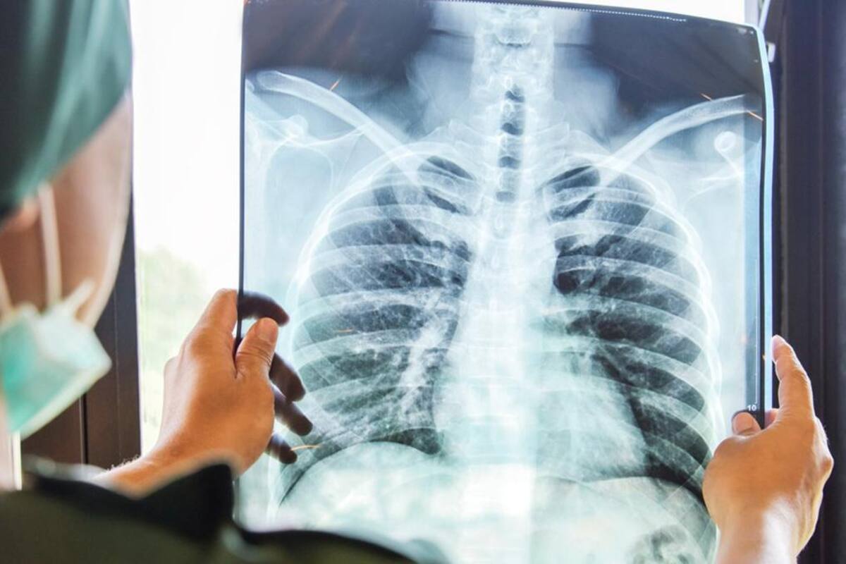 Cáncer de pulmón amenaza cada año a 7 mil mexicanos