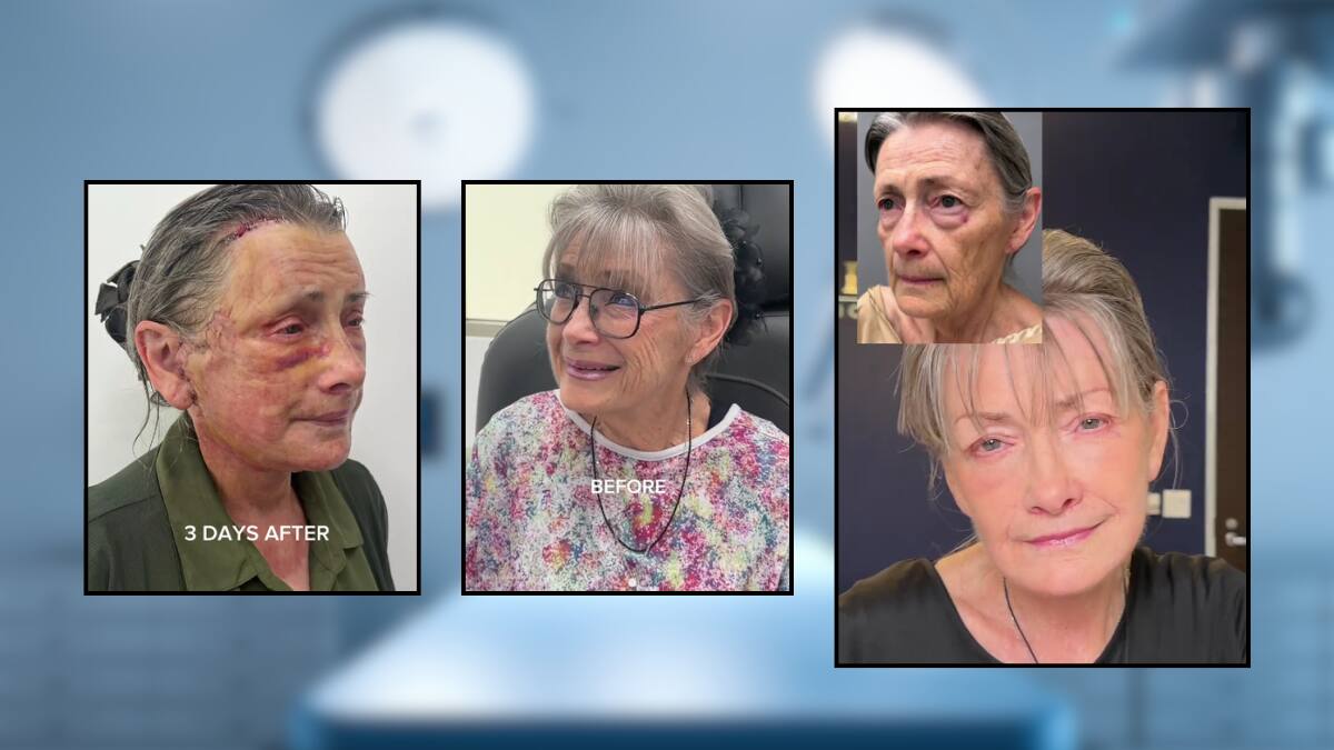 Cirujano plástico de Beverly Hills logró rejuvenecer décadas a una mujer de 70 años: así fue el increíble resultado