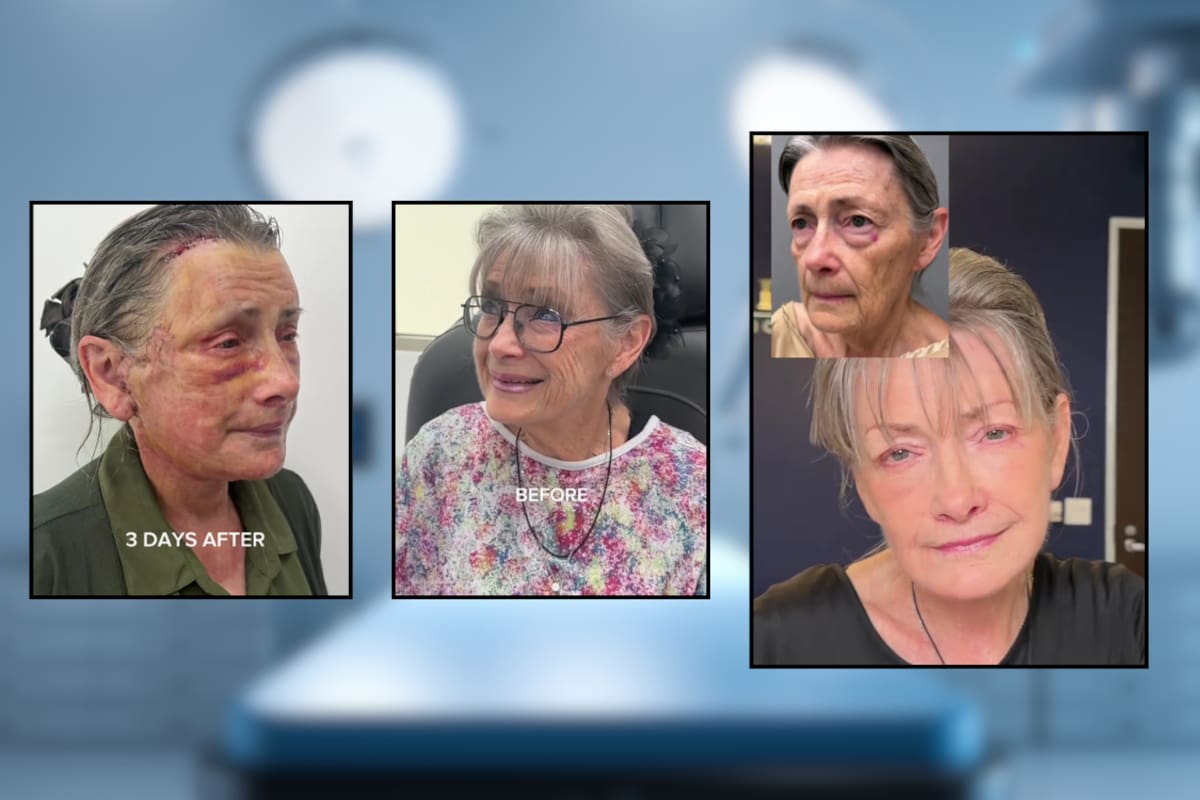 Cirujano plástico de Beverly Hills logró rejuvenecer décadas a una mujer de 70 años: así fue el increíble resultado