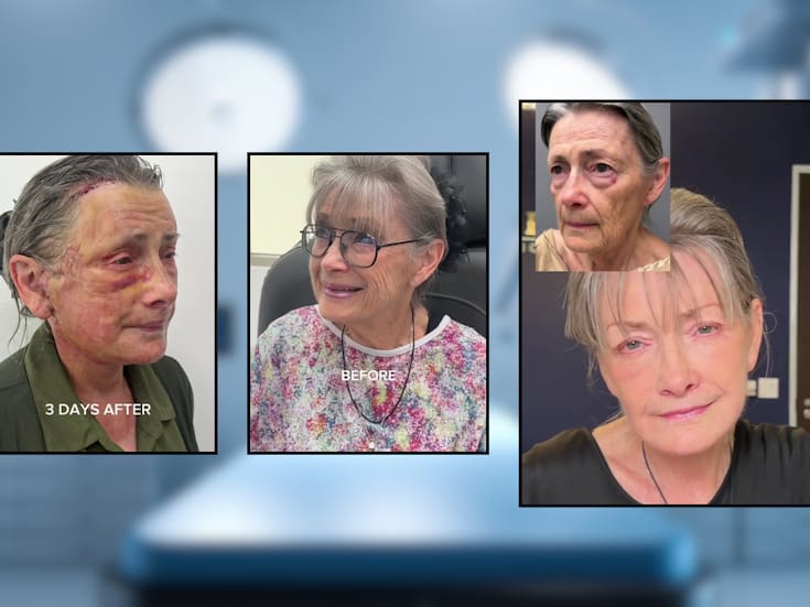Cirujano plástico de Beverly Hills logró rejuvenecer décadas a una mujer de 70 años: así fue el increíble resultado