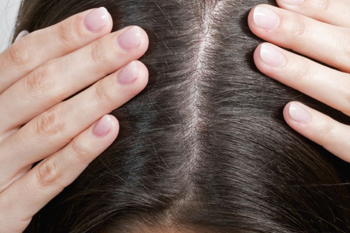 Dile adiós a la caspa con aceite de oliva y limón