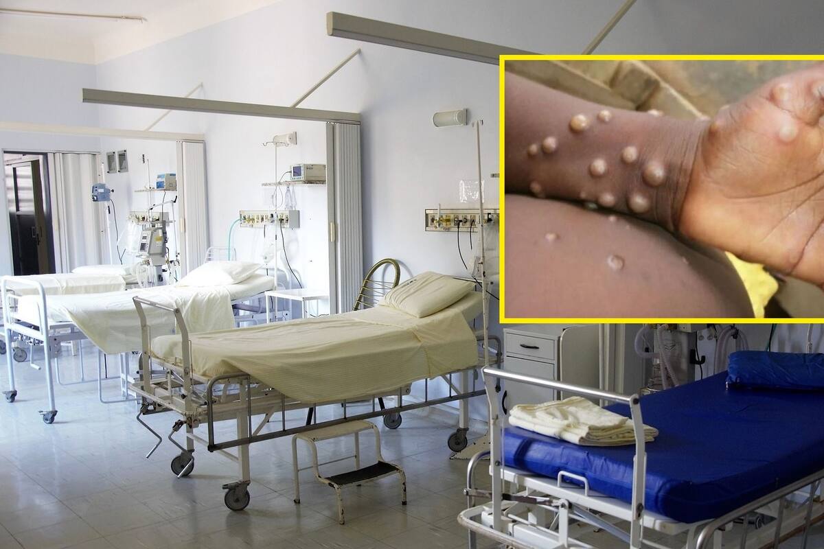 Primera muerte por viruela símica en Quintana Roo mantiene en alerta a la Secretaría de Salud