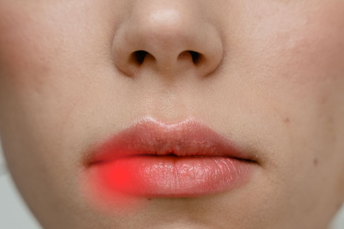 Vínculo entre el herpes labial y el Alzheimer: un hallazgo que cambia la perspectiva médica