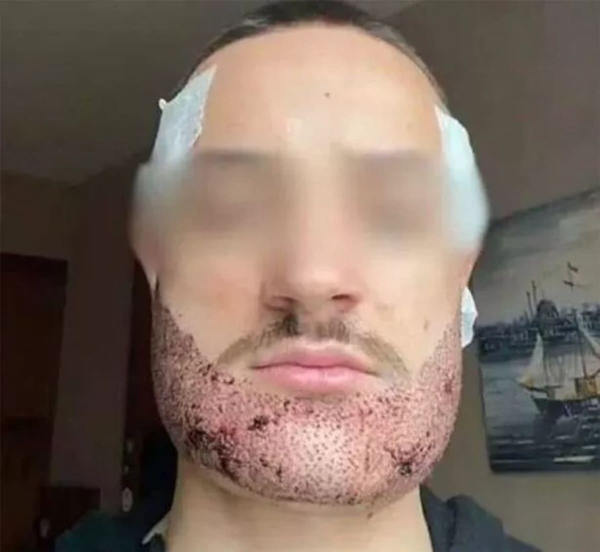 Mathieu Vigier Latour después de la cirugía. Foto familiar vía The Mirror