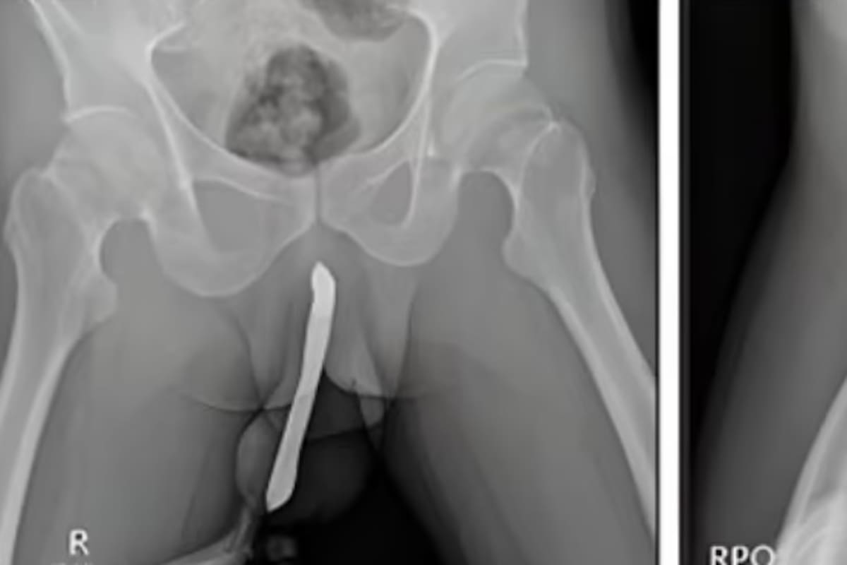 Indonesio experimenta intenso dolor tras romperse un cepillo de dientes dentro de su pene durante relaciones sexuales