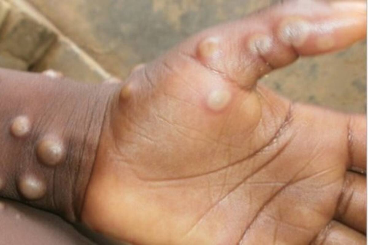 ¿La viruela del mono es una enfermedad de transmisión sexual?