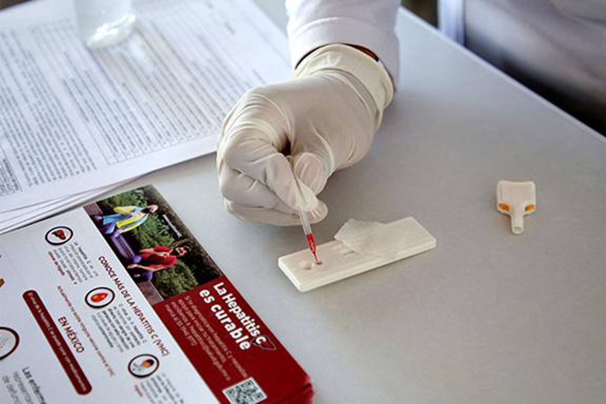 ¿Cómo se puede convertir la hepatítis en cáncer epático?