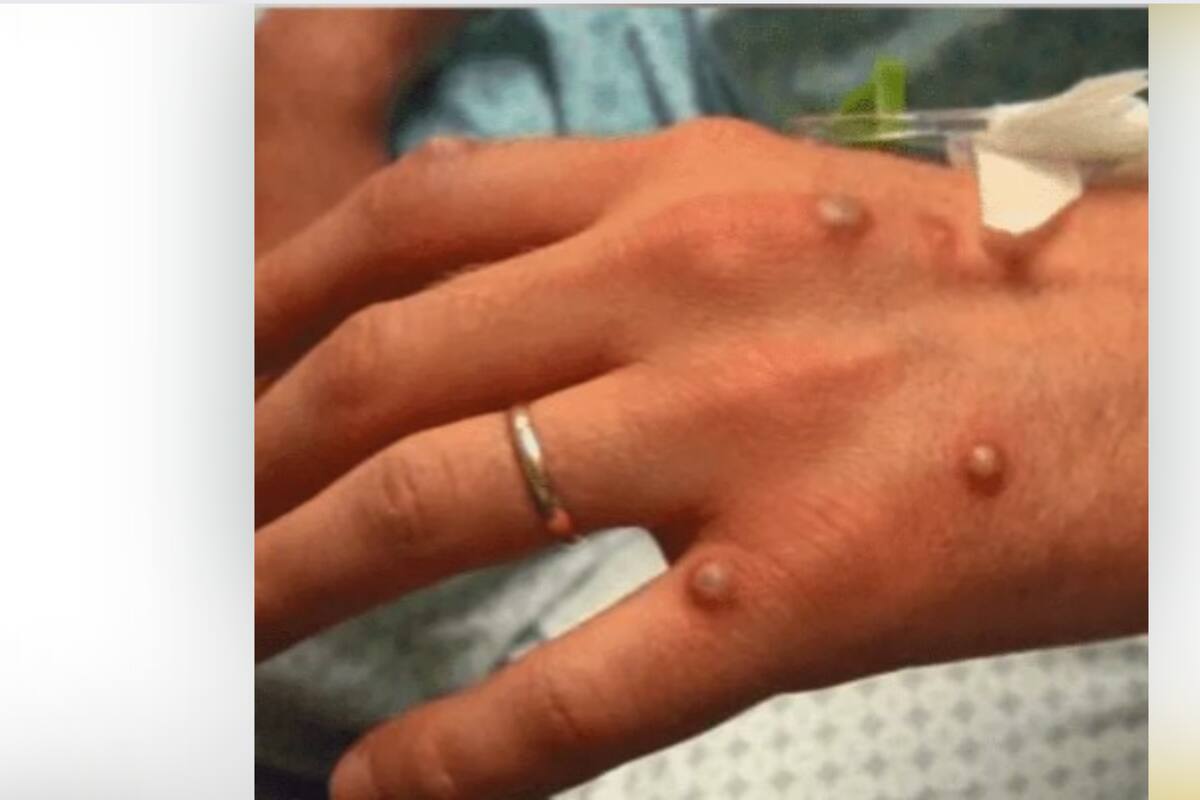 Huye de México turista estadounidense infectado con la Viruela del Mono que vacacionaba en Puerto Vallarta, Jalisco