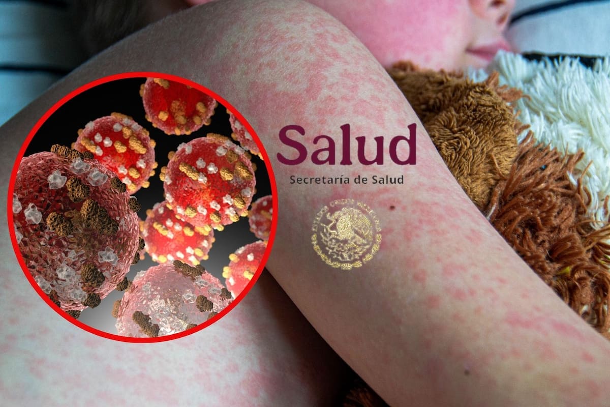 Secretaría de Salud alerta sobre viajes a EEUU y Canadá por brotes de sarampión