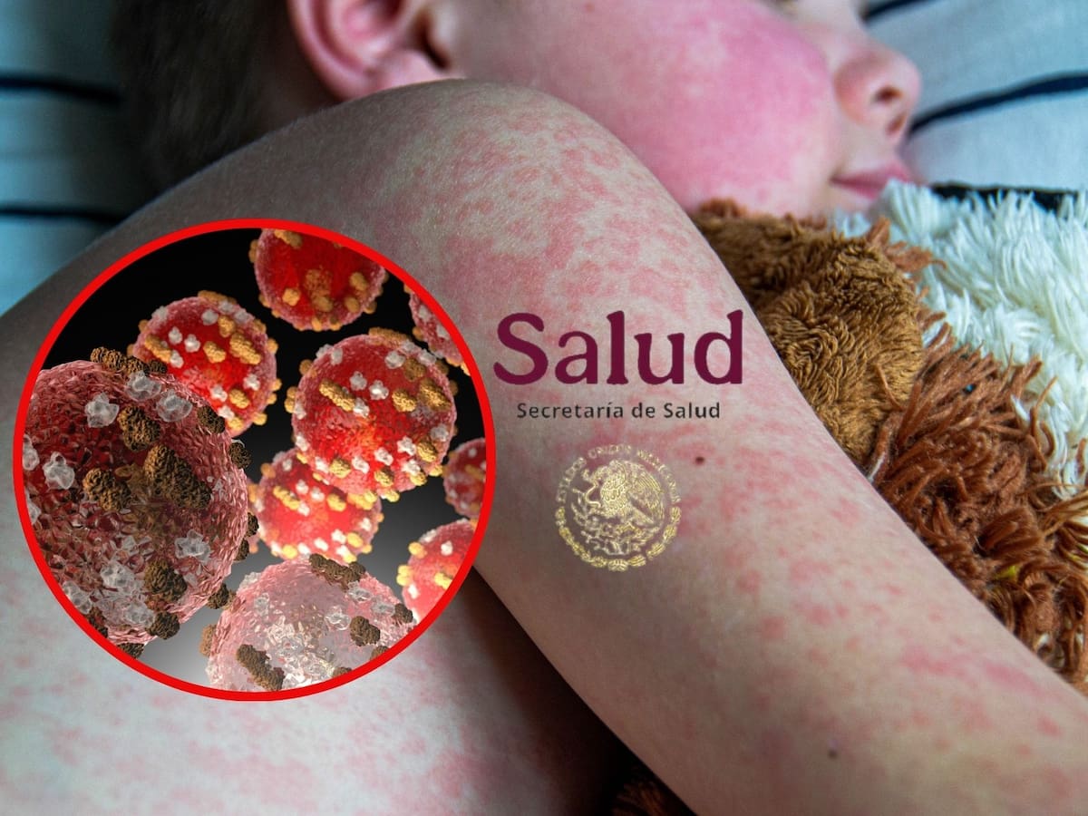 Sarampión en aumento: México advierte sobre viajes a EEUU y Canadá. | Crédito: Canva/Especial